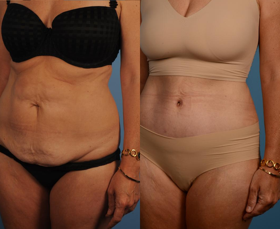 NATRAVOR® AuréLuxe Body Firming Oil image NATRAVOR® AuréLuxe Body Firming Oil