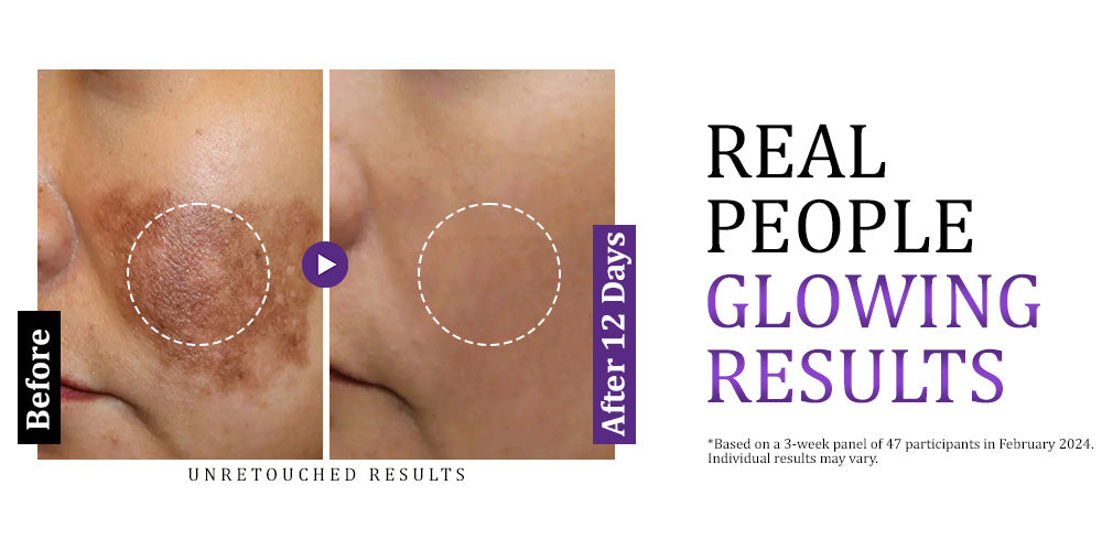 Furzero™ EPIGLOW MelanEX Advanced Cream