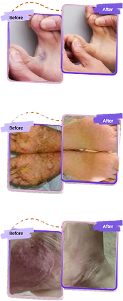 HZA™ FungiVanish Foot Treatment Spray