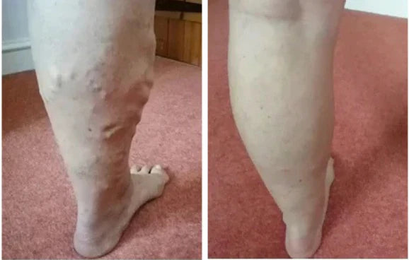 YUNPSO™ MicroVeno Microneedle Terapiya Yaması 28 YUNPSO™ MicroVeno Microneedle Terapiya Yaması