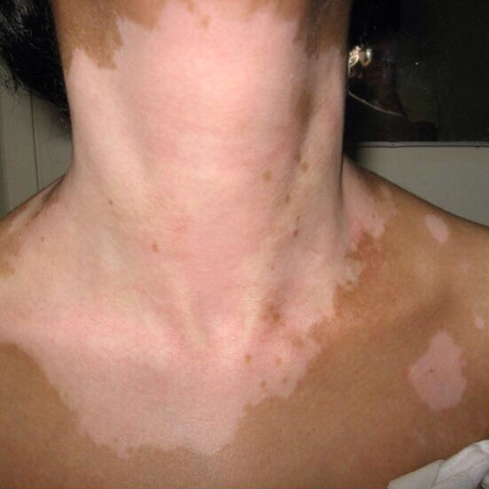 YUNPSO® VitiHeali Yellowjacket Neurotoxic fluid Extractm Cream Ultra 40 YUNPSO® VitiHeali Yellowjacket Neurotoxic fluid Extractm Cream Ultra