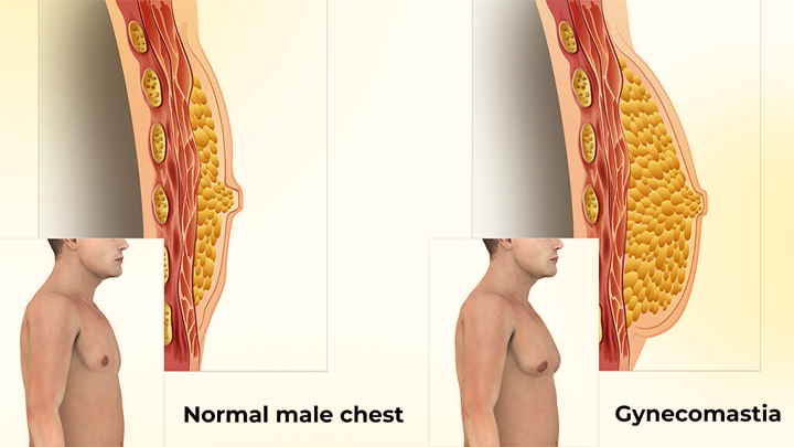 AnnieCare® ThermoFirm Bee Venom Gynecomastia-Oil 21 AnnieCare® ThermoFirm Bee Venom Gynecomastia-Oil