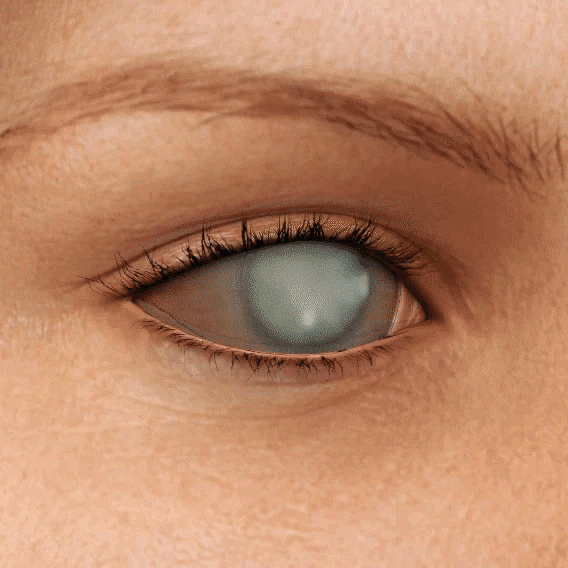 LAOZIK™ OptiFusion Nano Eye Drops Serum —Nano Technology Restores Clear Vision, No Glasses, No Surgery