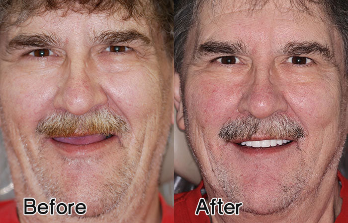 LAOZIK-Advanced customized complete denture set 19 LAOZIK-Advanced customized complete denture set