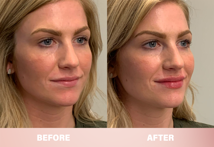 LIMETOW® Lip Plumper Kit image LIMETOW® Lip Plumper Kit