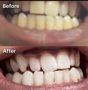 Miraloud™ Tooth Polish - Instant Clean Smile