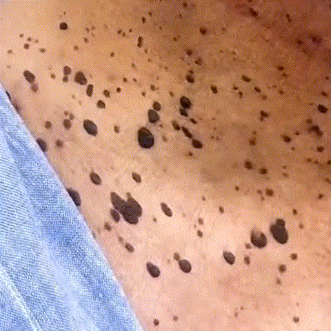 Yunpso™ MicroNeedle Botanic Skin Tag Removal Patch