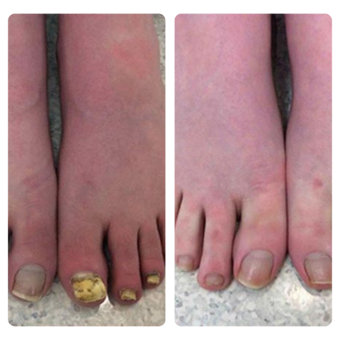 HZA™ FungiVanish Foot Treatment Spray