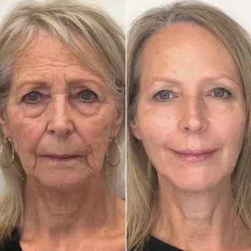 Furzero™ Botox anti-wrinkle serum with bee venom