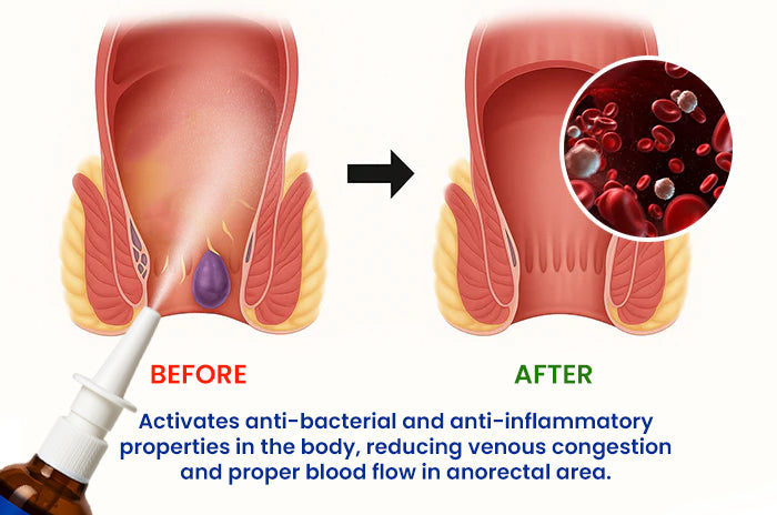 Cvreoz® Herbal Hemorrhoid Treatment Anal Spray