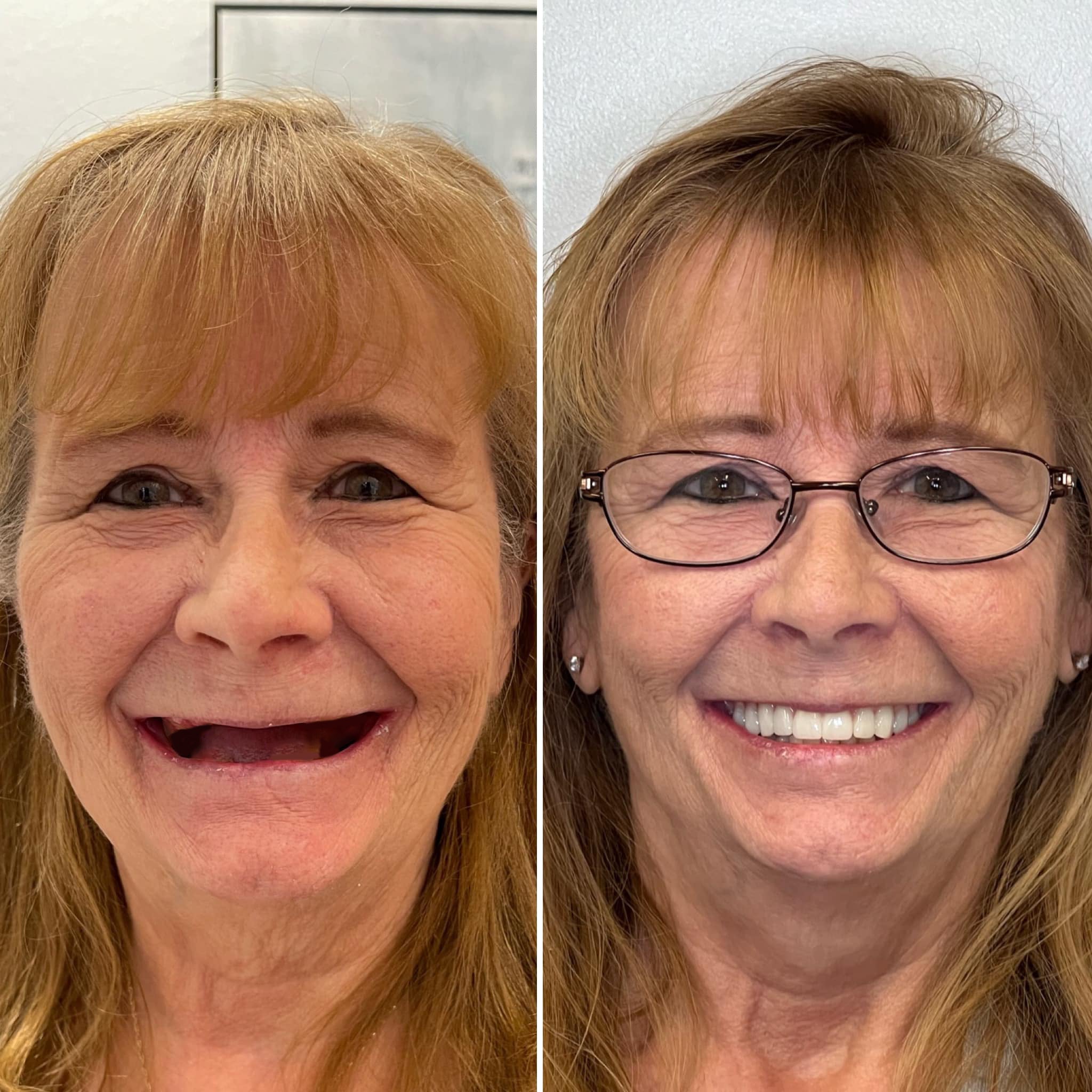 YUNPSO™ Thermoplastic Denture Adhesive