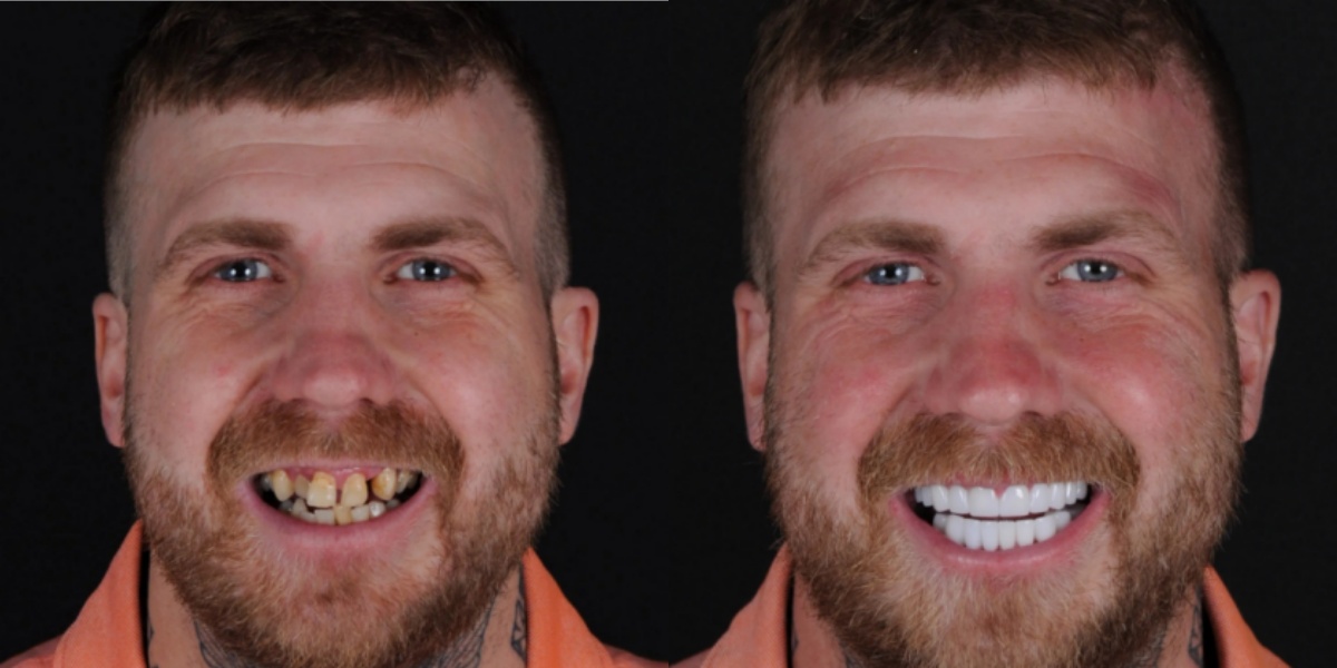 LAOZIK™ Custom-Fit Functional Dentures image LAOZIK™ Custom-Fit Functional Dentures