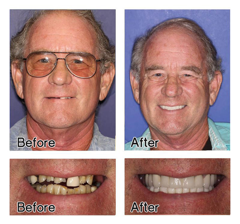 LAOZIK-Advanced customized complete denture set 18 LAOZIK-Advanced customized complete denture set