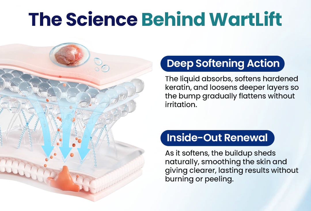 Timilk® WartLift Corn Removal Liquid (A)