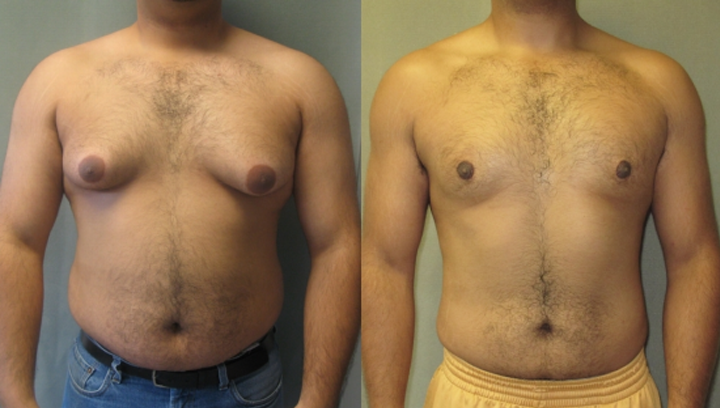 AnnieCare® ThermoFirm Bee Venom Gynecomastia-Oil 25 AnnieCare® ThermoFirm Bee Venom Gynecomastia-Oil