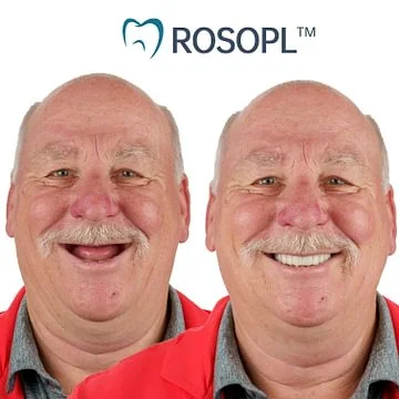 ROSOPL™ Functional Dentures – Dentist Recommended for Seniors 45+ | Made in USA | FDA Cleared