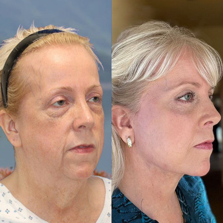 Furzero™ Botox anti-wrinkle serum with bee venom