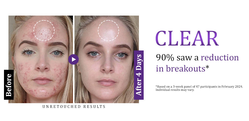 Furzero™ EPIGLOW MelanEX Advanced Cream