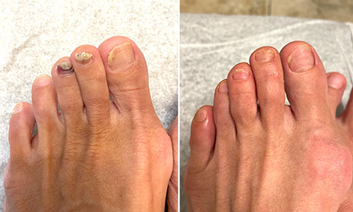 Biancat® AeroFilm Foot Defense Mist