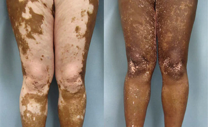 YUNPSO® VitiHeali Yellowjacket Neurotoxic fluid Extractm Cream Ultra 43 YUNPSO® VitiHeali Yellowjacket Neurotoxic fluid Extractm Cream Ultra