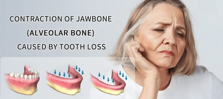 Jawbone Contraction